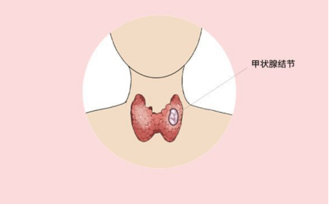 甲狀腺有這些症狀時不能大意,預防更重要,常用手摸一摸|甲狀腺癌|變聲