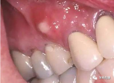 局部牙槽脓肿图片图片