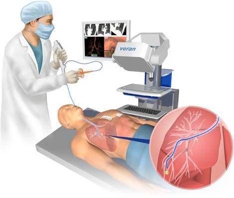 发现了肺结节要确诊肺癌是做穿刺活检还是petct