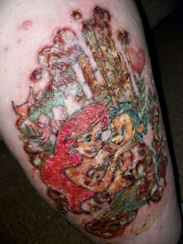 希瑟说:"起初,我认为纹身上的蓝色墨水是引起反应的原因.