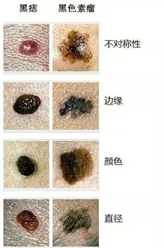 小心是黑色素瘤|黑色素瘤|癌变|恶性黑色素瘤|黏膜黑色素瘤|化疗|肿瘤