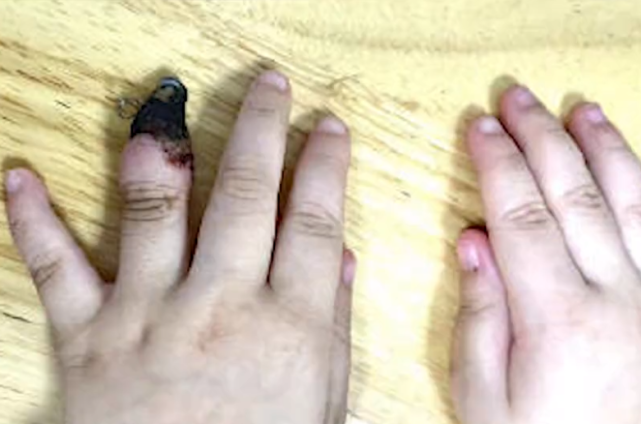 女孩子手指受伤的照片图片