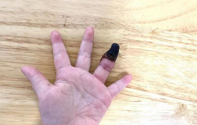 家人错误包扎,3岁女童手指坏死被截指