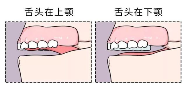 真正口呼吸的孩子,呼吸时舌头通常放在口腔下方.