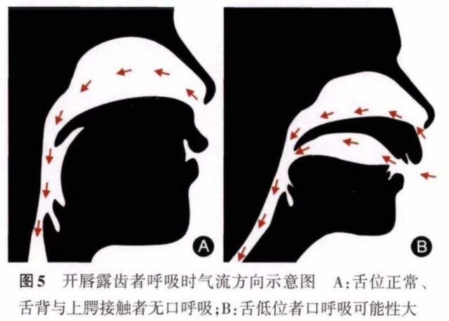 因为有的孩子虽然张着嘴巴呼吸,但舌头抵在上颚,气流基本不会从口腔