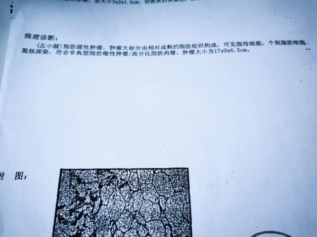 脂肪瘤|肉瘤|肿瘤|肿块|彩超|癌症|脂肪肉瘤