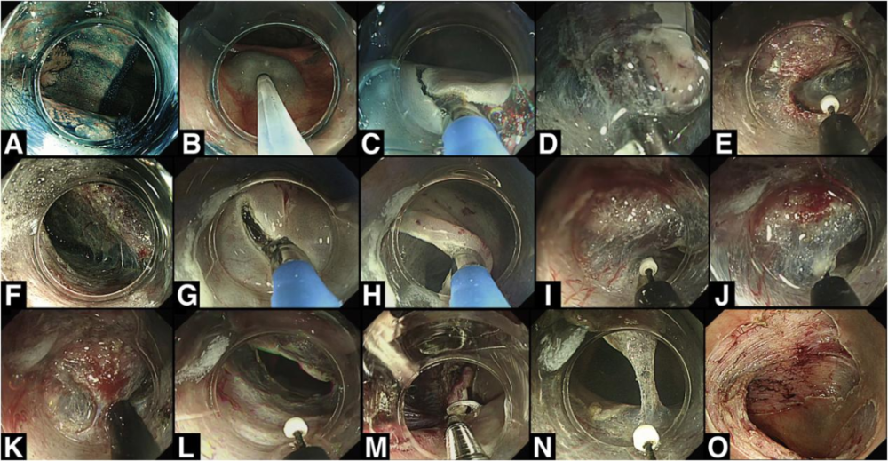 (a, b) if a reversal position is possible, commence endoscopic