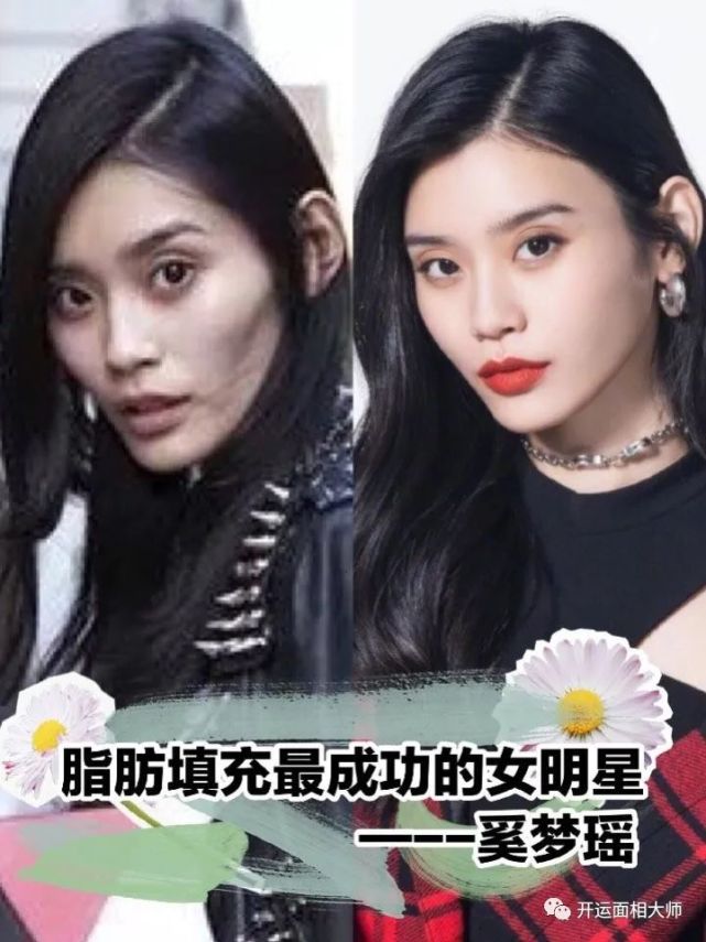 奚梦瑶大概是脂肪填充最成功的女明星?