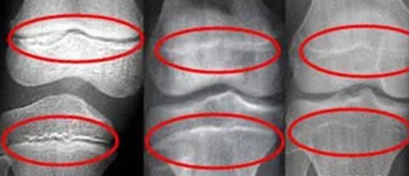 12岁女孩152cm,骨骺线即将闭合,提醒:2个特征未出现,尽快补救