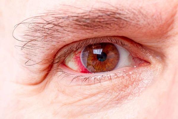 视网膜病变,是糖尿病并发症之一,眼睛出现5种情况,需重视