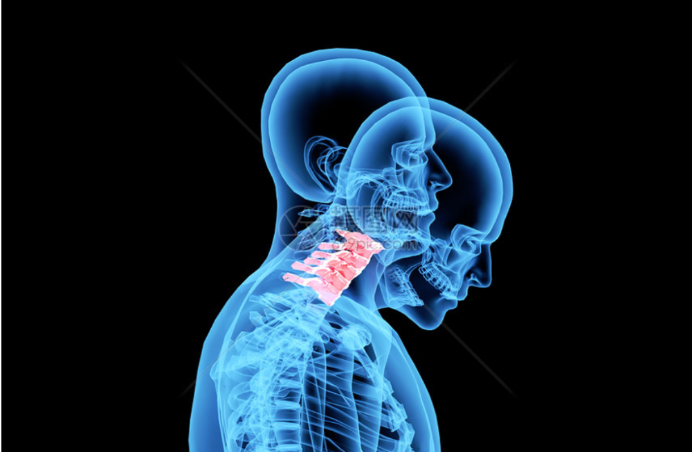 最常见的表现:颈部强直,疼痛或肩背疼痛发僵;可能还会有颈部,背部僵硬