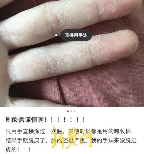 全网都在刷酸?美容博主纷纷分享教程,国家药监局却这样说