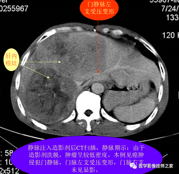 上腹部ct平掃&增強病例斷層解讀