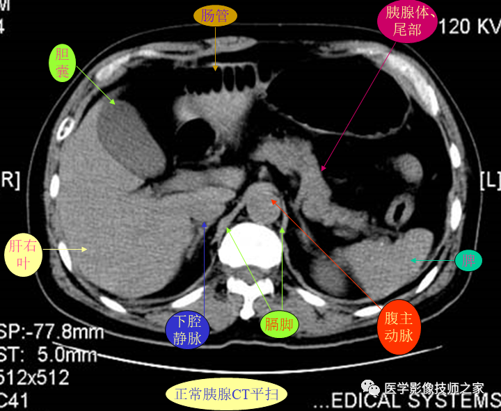 上腹部ct平扫&增强病例断层解读