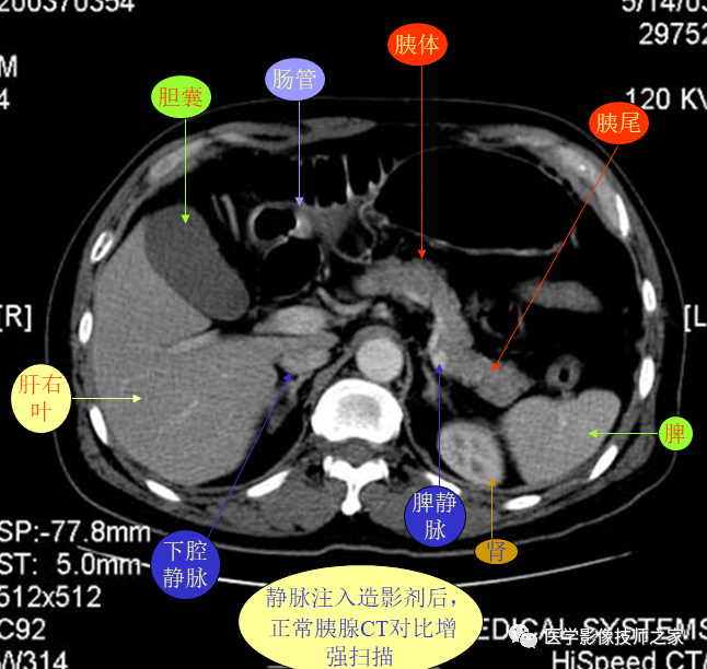 上腹部ct平掃增強病例斷層解讀