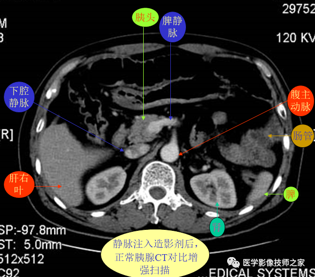 上腹部ct平扫&增强病例断层解读