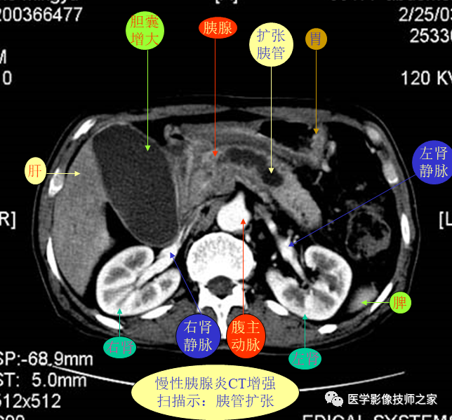 上腹部ct平扫&增强病例断层解读