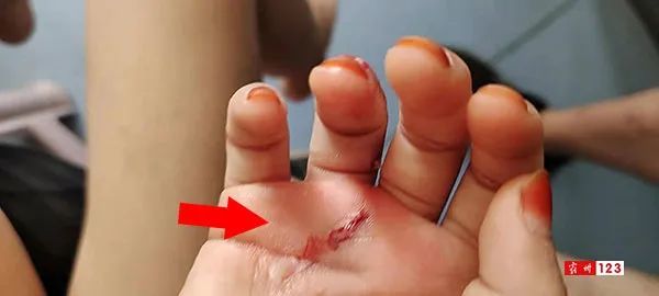 令人心痛视频霸州7岁小女孩被疯狗不停撕咬