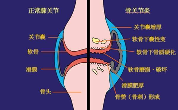 增生性骨關節病你瞭解多少?