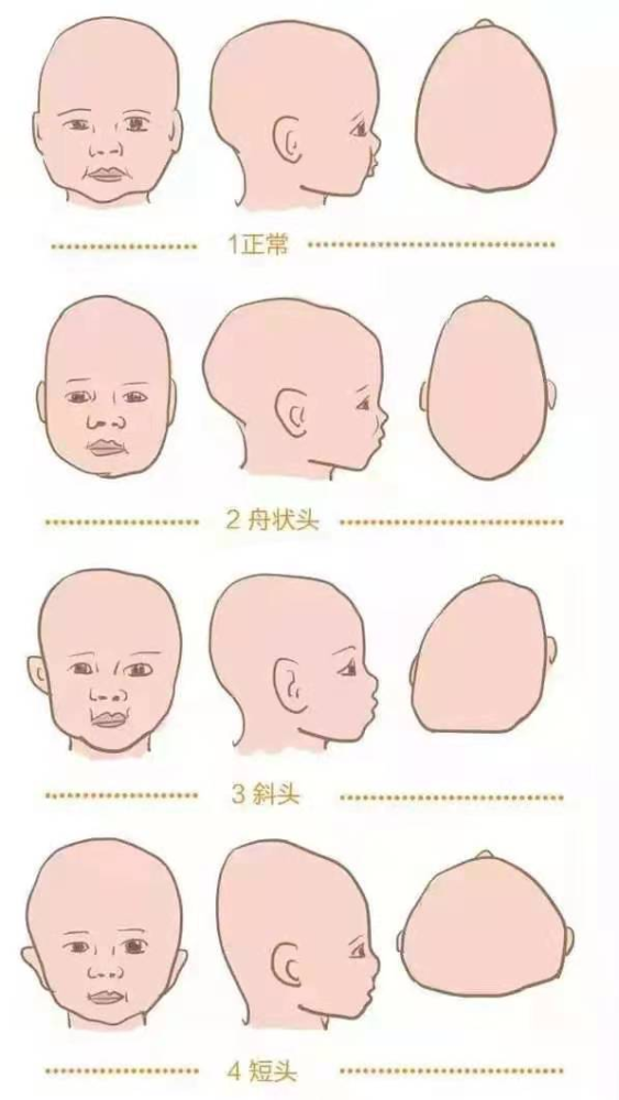 扁头是天生的还是睡出来的