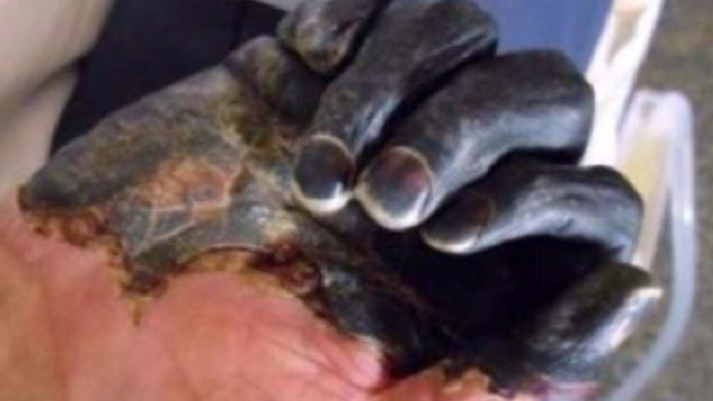 宁夏报告1例甲类烈性传染病鼠疫历史上的黑死病如何早发现早预防