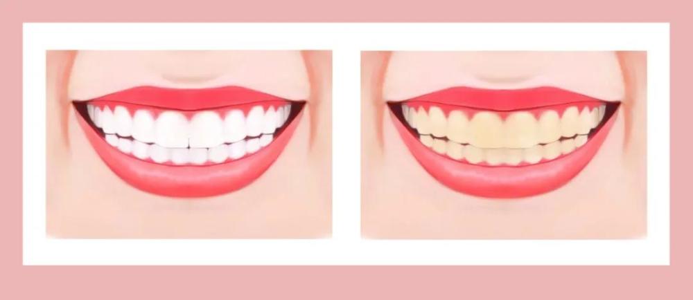 q:牙齿泛黄到底有多让人难以接受?