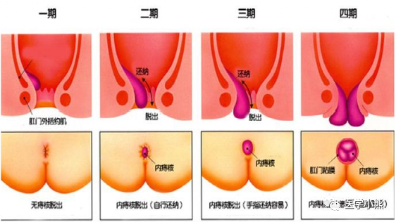 如下圖,沒有脫出屬於一期,排便時候痔瘡脫出,就是這個肉球,但便後肉球