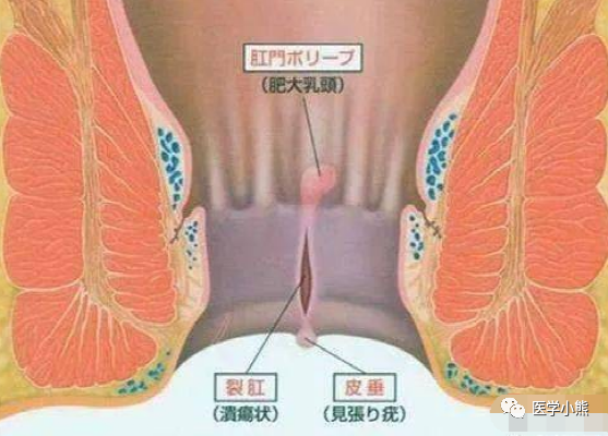 反覆發作後才會出現向肛門外突出的肉球,也叫哨兵痔,肛裂,肛乳頭肥大