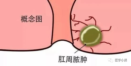 肛門外有個肉球是怎麼回事?