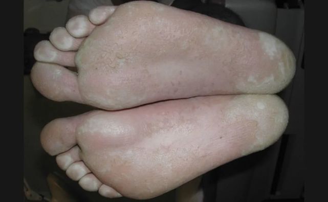 脚底板出现很多坑坑洼洼的小洞,是咋回事|角质|松解|足底|袜子