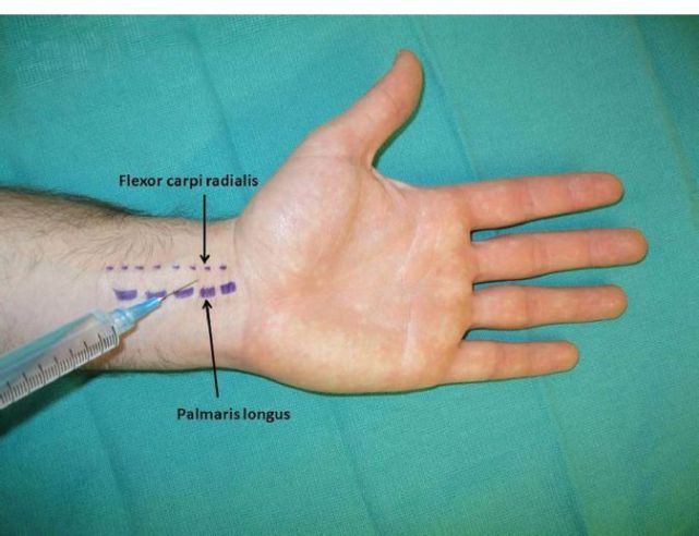 flexor carpi radialis图片