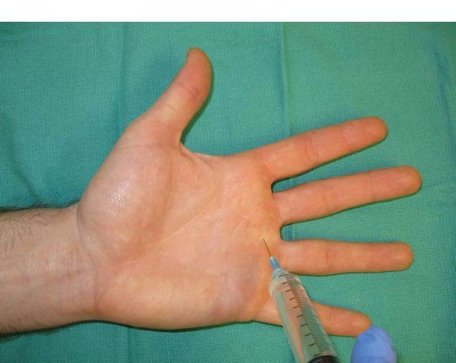 一针封闭减寿半年医生辟谣给您讲清封闭治疗的利与弊