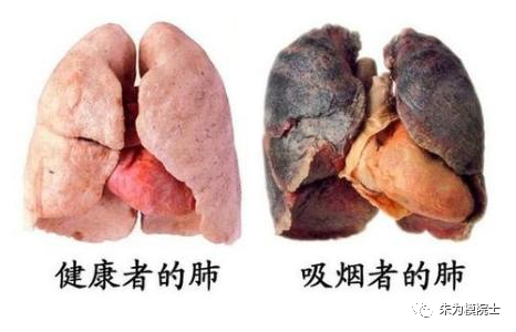 最常見的因吸菸引起的疾病包括:肺癌,口腔癌,喉癌,膀胱癌,腎臟癌