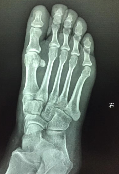 一例运用足外斜位的病例,比较少见!