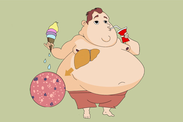 12岁男孩超重15公斤,被查出脂肪肝,只有肥胖人群要警惕脂肪肝?