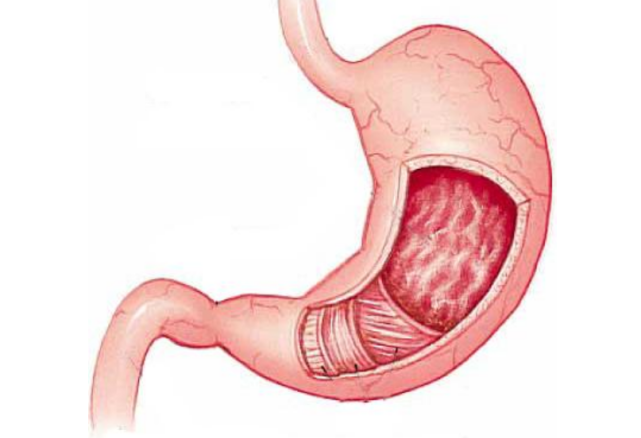 胃黏膜是保護胃部的一道屏障修復胃黏膜的方法要學會用