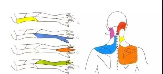 但是颈椎病为什么会引发手麻?
