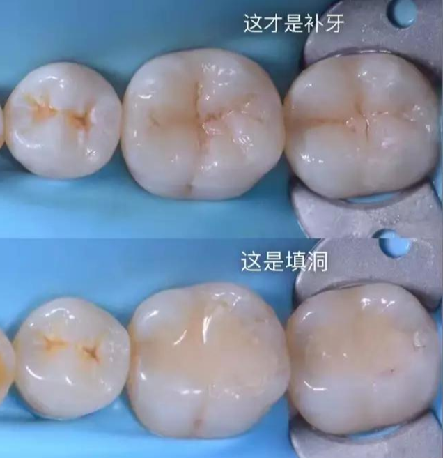 补牙简单吗专家补牙与填洞可是有区别的