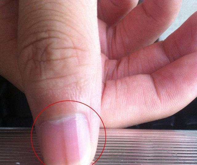 指甲出现竖纹与什么因素有关该如何改善建议了解