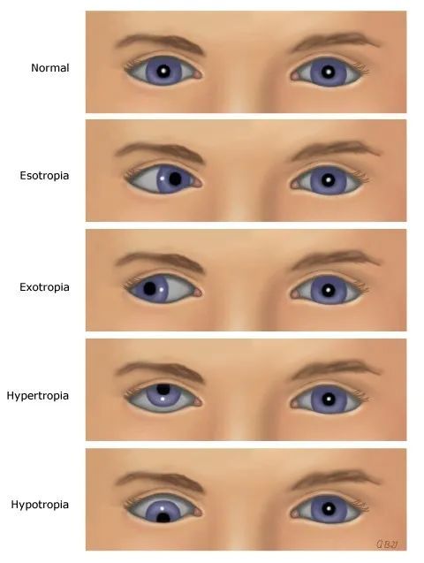 孩子"歪头斜眼"要注意,可能是斜视惹的祸,要尽早治疗!