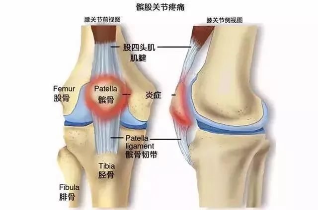 髕骨骨折後應注意什麼