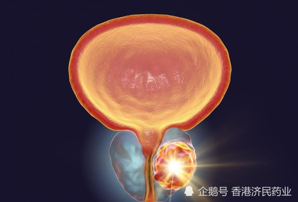 talazoparib在ii期前列腺癌试验中获得阳性数据