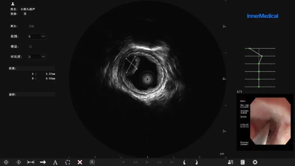 小探头超声内镜图片