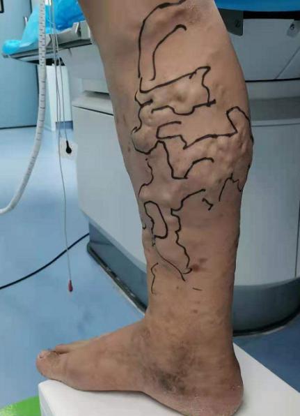 小腿居然长满"蚯蚓" 介入治疗消除深圳阿叔10年困扰