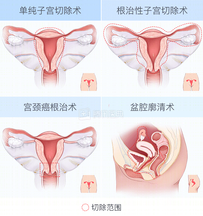 女人切除子宮後會迅速變老嗎