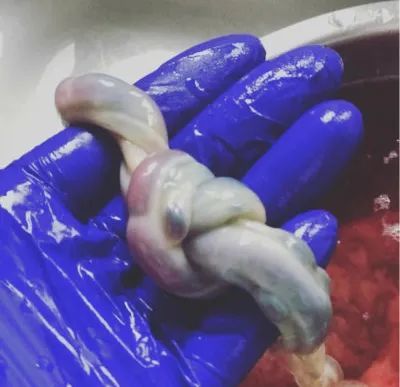 8个月宝宝胎死腹中可怕的脐带扭转让医生都吓出一身冷汗