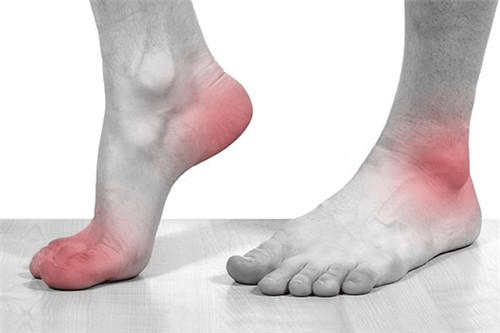 对于尿酸升高,并且出现关节疼痛的人群,首先应积极就医诊治,明确有无