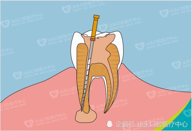 根管治療後牙齒會怎麼樣醫生告訴你根管後牙齒還可以用多久