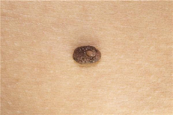 脖子上不痛不痒的小肉球是什么能用手抠吗医生带你认识丝状疣