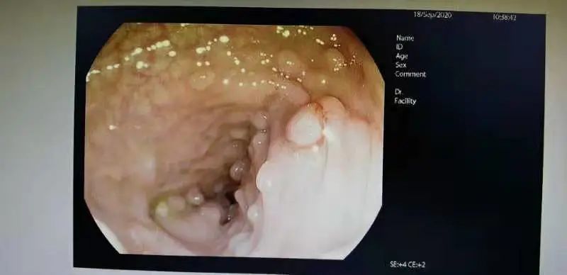 太可怕因家族遗传福州23岁妙龄女每年切下几十枚息肉